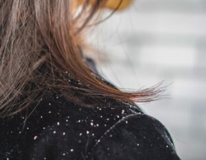 Keep an eye out for dandruff symptoms